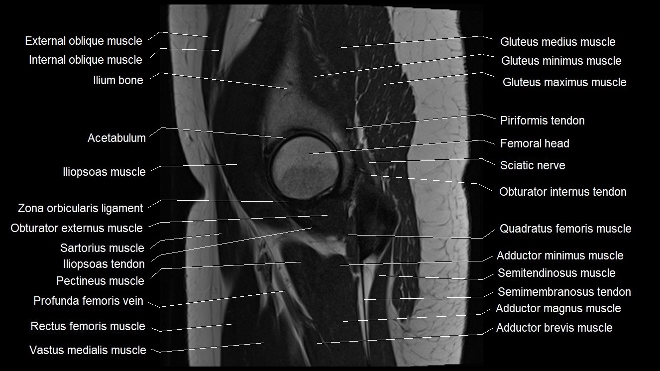 Hip sagittal cross sectional anatomy image 19.webp
